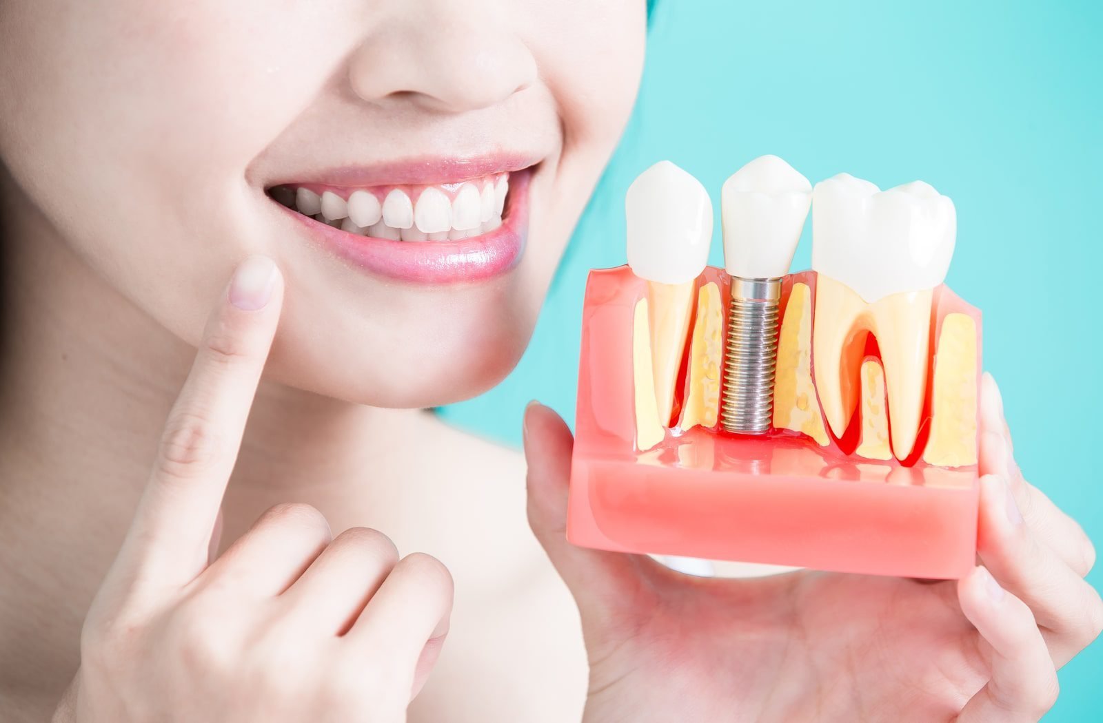 The Benefits of Dental Implants vs. Other Tooth Replacement Options