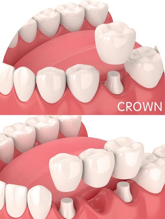 Best Crown & Bridges